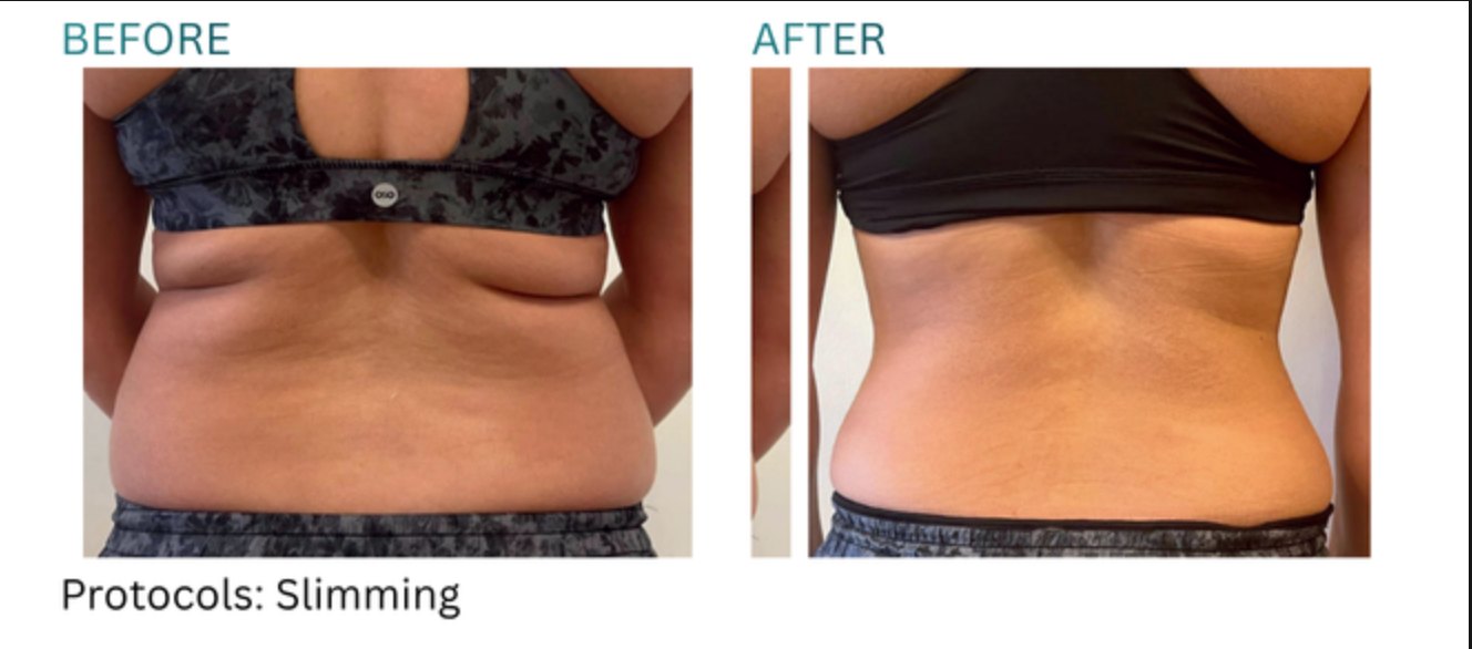 Before and after, back and abdomen, slimming