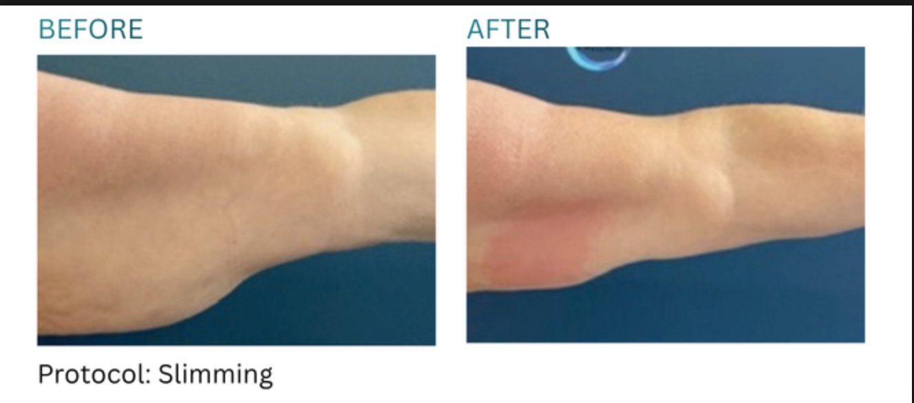 Before and after, arm, slimming
