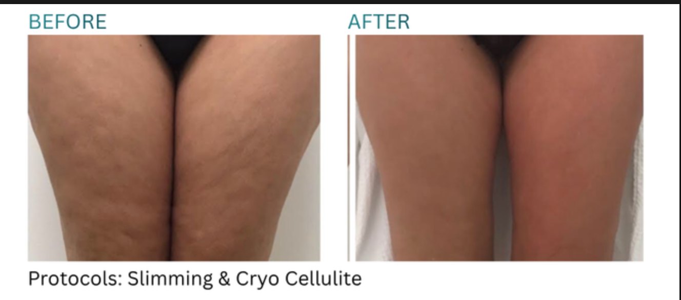 Before and after, thighs, slimming and cryo cellulite